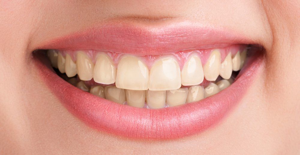 Avant Blanchiment Dents / Before Teeth Whitening