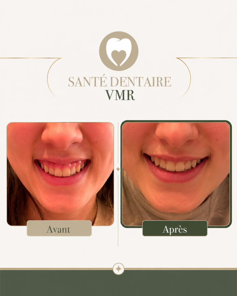 botox avant-apres VMR botox VMR